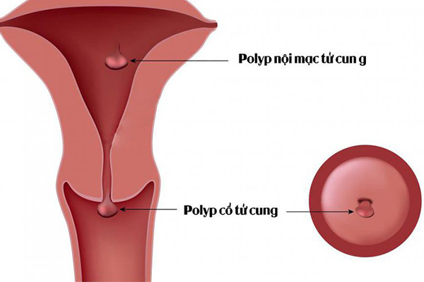 Polyp tử cung: Dấu hiệu, nguyên nhân và cách điều trị