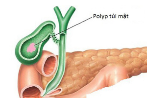 Polyp túi mật: Dấu hiệu, nguyên nhân và phương pháp điều trị