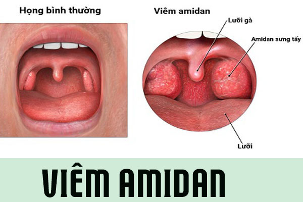 Viêm Amidan : Dấu hiệu, nguyên nhân và phương pháp điều trị
